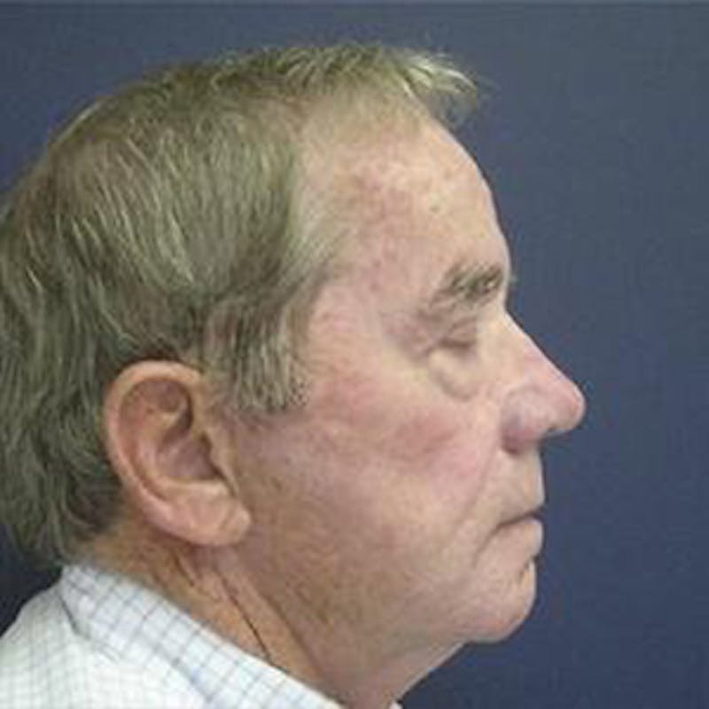 Facelift Before & After Gallery - Patient 802749 - Image 1