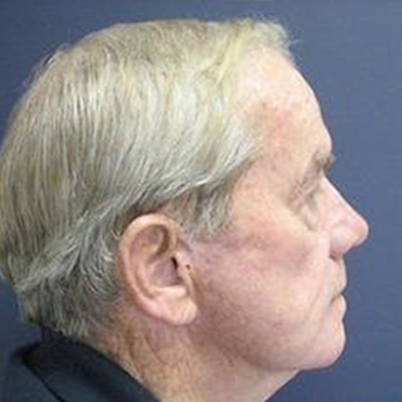 Facelift Before & After Gallery - Patient 802749 - Image 2