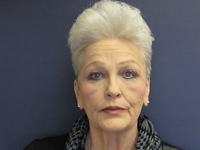 Facelift Before & After Gallery - Patient 222594 - Image 1