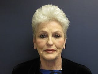 Facelift Before & After Gallery - Patient 222594 - Image 2