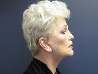 Facelift Before & After Gallery - Patient 222594 - Image 4