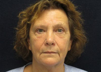 Facelift Before & After Gallery - Patient 182239 - Image 1