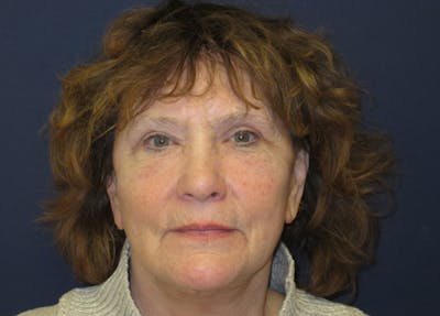 Facelift Before & After Gallery - Patient 182239 - Image 2