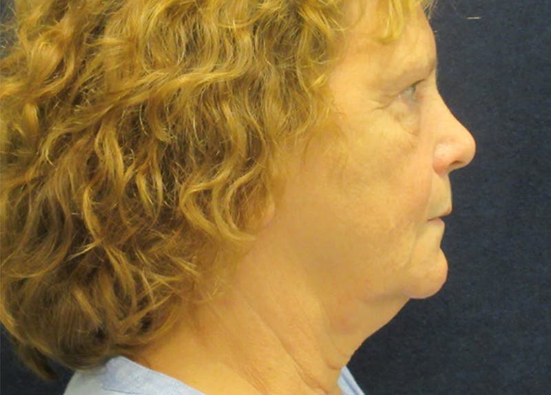 Facelift Before & After Gallery - Patient 182239 - Image 3