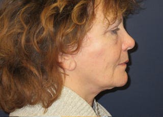 Facelift Before & After Gallery - Patient 182239 - Image 4