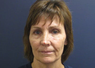 Facelift Before & After Gallery - Patient 199669 - Image 1