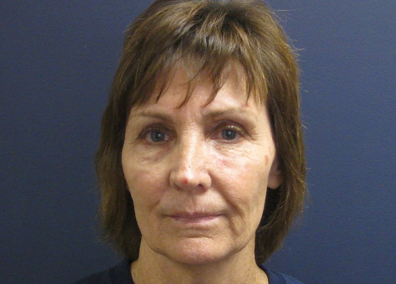 Facelift Before & After Gallery - Patient 199669 - Image 1