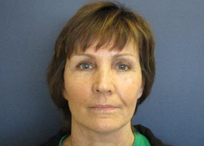 Facelift Before & After Gallery - Patient 199669 - Image 2