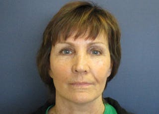 Facelift Before & After Gallery - Patient 199669 - Image 2