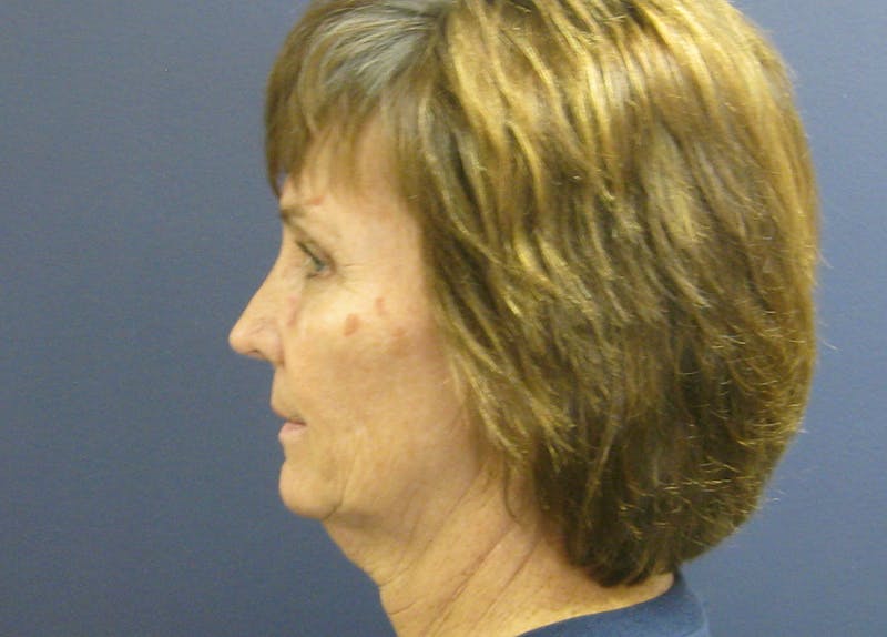 Facelift Before & After Gallery - Patient 199669 - Image 3