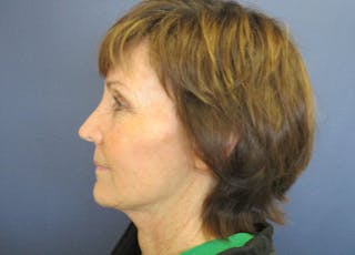 Facelift Before & After Gallery - Patient 199669 - Image 4