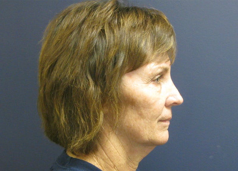 Facelift Before & After Gallery - Patient 199669 - Image 5