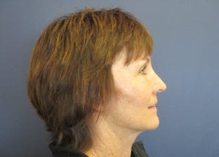 Facelift Before & After Gallery - Patient 199669 - Image 6