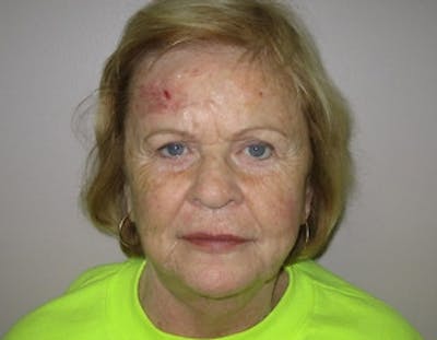 Facelift Before & After Gallery - Patient 264806 - Image 1