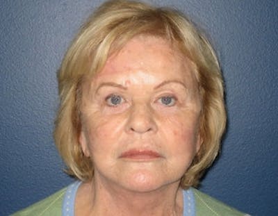 Facelift Before & After Gallery - Patient 264806 - Image 2