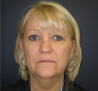 Mini Facelift Before & After Gallery - Patient 401162 - Image 1