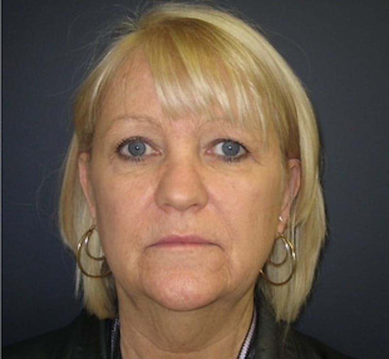 Mini Facelift Before & After Gallery - Patient 401162 - Image 1