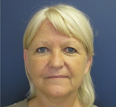 Mini Facelift Before & After Gallery - Patient 401162 - Image 2