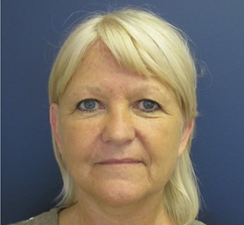 Mini Facelift Before & After Gallery - Patient 401162 - Image 2