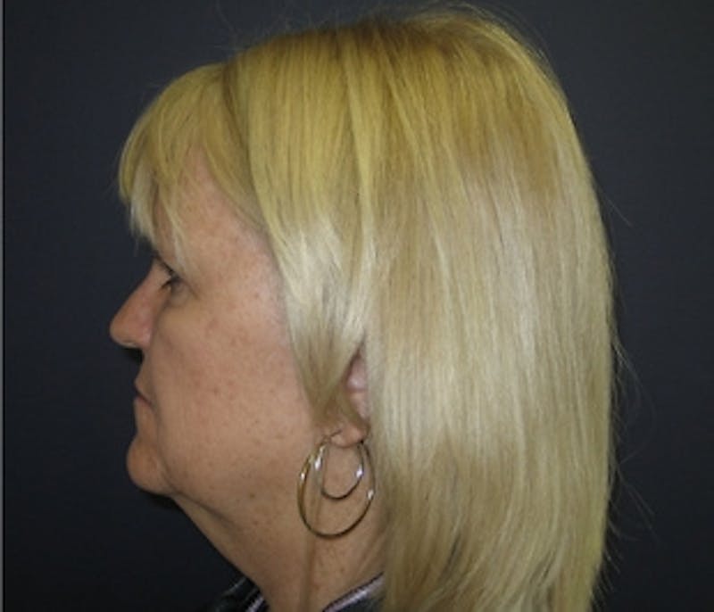 Mini Facelift Before & After Gallery - Patient 401162 - Image 3