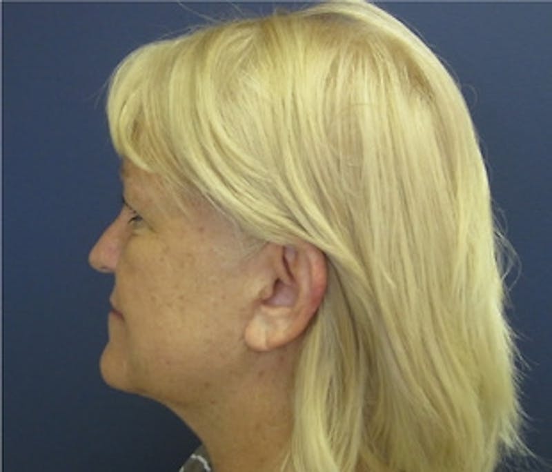 Mini Facelift Before & After Gallery - Patient 401162 - Image 4