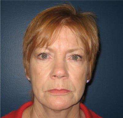 Mini Facelift Before & After Gallery - Patient 350822 - Image 1