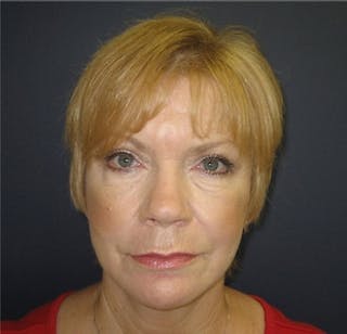 Mini Facelift Before & After Gallery - Patient 350822 - Image 2