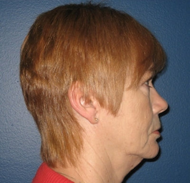 Mini Facelift Before & After Gallery - Patient 350822 - Image 3