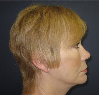 Mini Facelift Before & After Gallery - Patient 350822 - Image 4