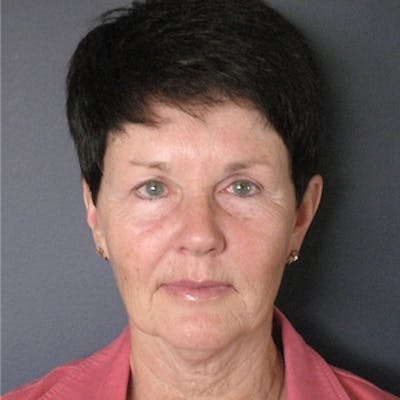 Mini Facelift Before & After Gallery - Patient 241068 - Image 1