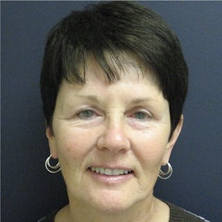 Mini Facelift Before & After Gallery - Patient 241068 - Image 2