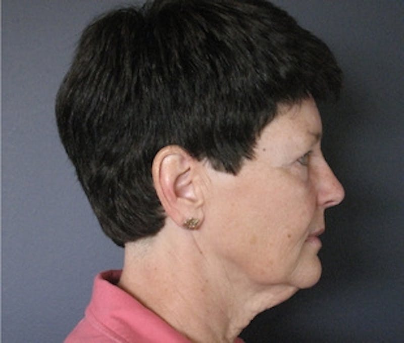 Mini Facelift Before & After Gallery - Patient 241068 - Image 3