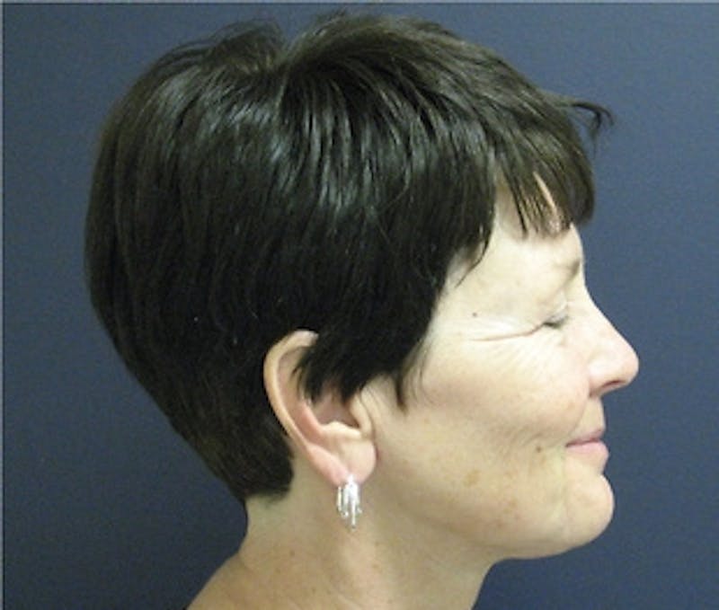 Mini Facelift Before & After Gallery - Patient 241068 - Image 4