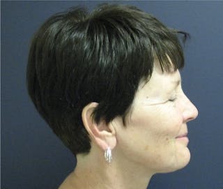 Mini Facelift Before & After Gallery - Patient 241068 - Image 4