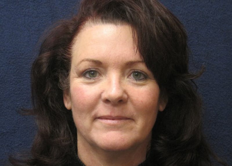 Mini Facelift Before & After Gallery - Patient 270073 - Image 1