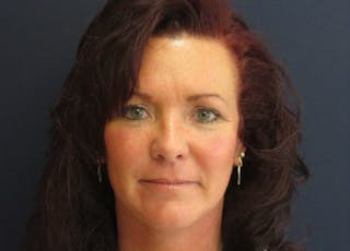 Mini Facelift Before & After Gallery - Patient 270073 - Image 2