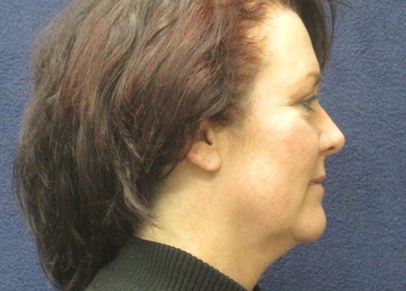 Mini Facelift Before & After Gallery - Patient 270073 - Image 3