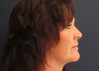 Mini Facelift Before & After Gallery - Patient 270073 - Image 4