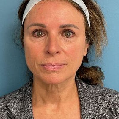 Neck Lift Before & After Gallery - Patient 110644 - Image 1