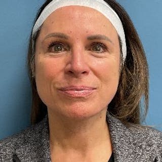 Neck Lift Before & After Gallery - Patient 110644 - Image 2
