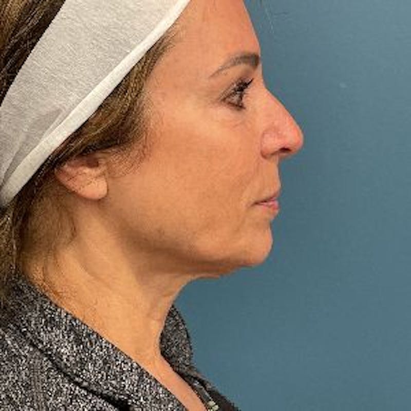 Neck Lift Before & After Gallery - Patient 110644 - Image 3