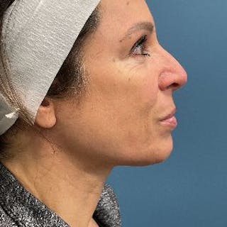 Neck Lift Before & After Gallery - Patient 110644 - Image 4