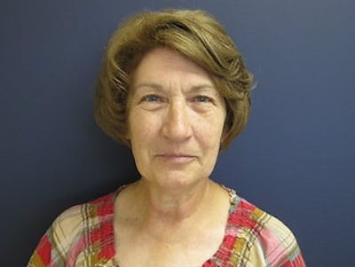 Neck Lift Before & After Gallery - Patient 299767 - Image 1