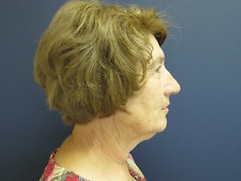 Neck Lift Before & After Gallery - Patient 299767 - Image 3