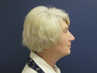 Neck Lift Before & After Gallery - Patient 299767 - Image 4