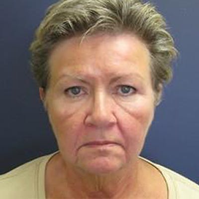 Neck Lift Before & After Gallery - Patient 290457 - Image 1