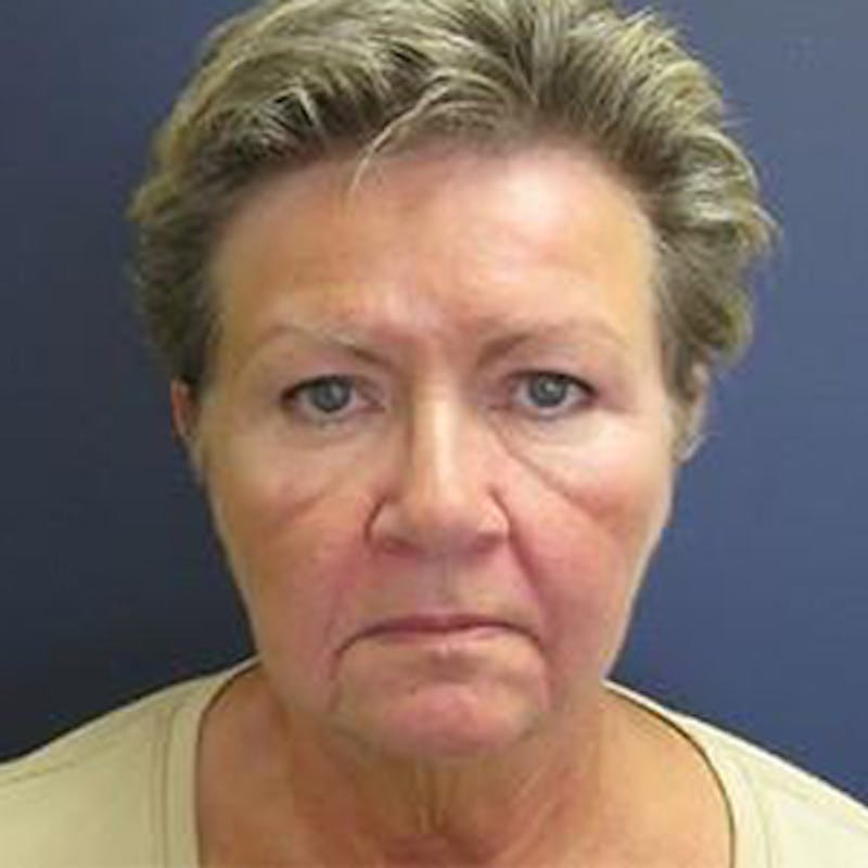 Neck Lift Before & After Gallery - Patient 290457 - Image 1