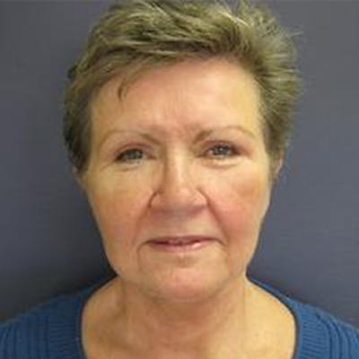 Neck Lift Before & After Gallery - Patient 290457 - Image 2