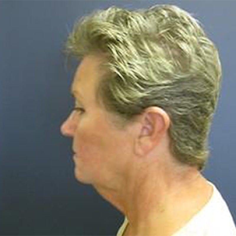 Neck Lift Before & After Gallery - Patient 290457 - Image 3