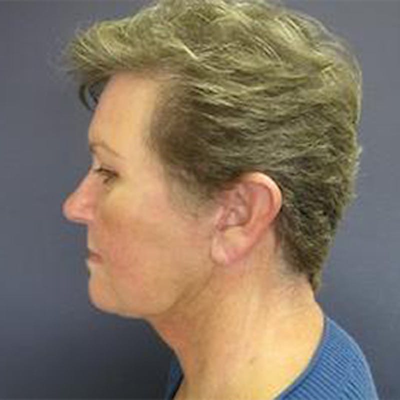 Neck Lift Before & After Gallery - Patient 290457 - Image 4